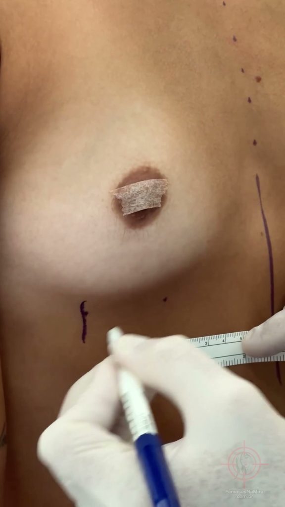 Cirurgião Mostra Bastidores, Antes e Depois de Operação de Key Alves